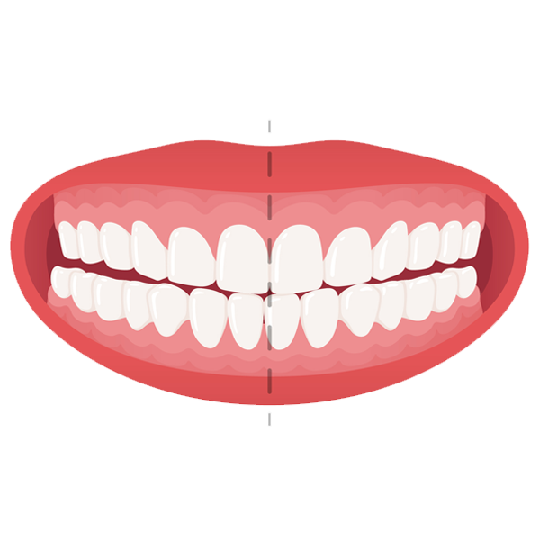 crossbite
