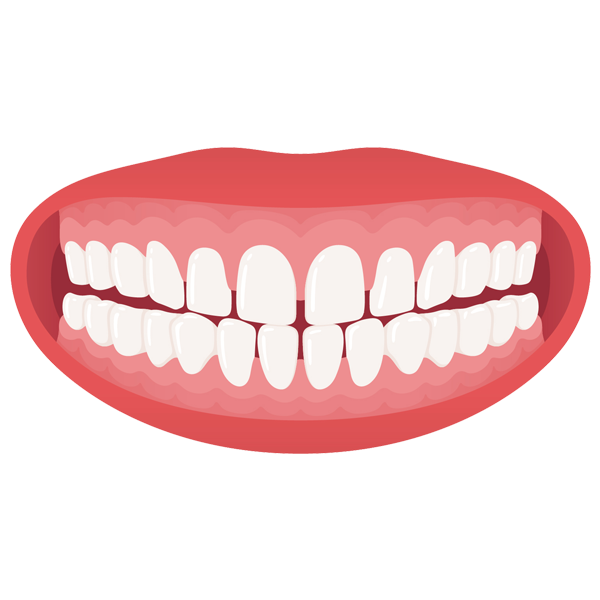 Gapped Teeth
